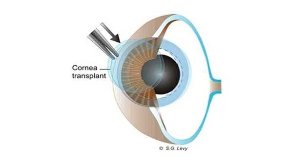 eye diagram depicting surgeon placing donor cornea into recipient's eye during cornea transplant surgery